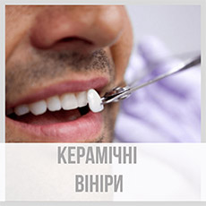 керамічні вiнiри