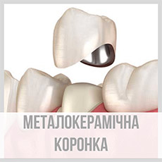 Металокерамічна коронка
