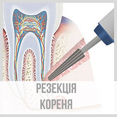 Резекція кореня