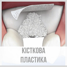 Кісткова пластика