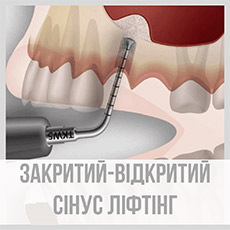 Закритий (відкритий) сінус ліфтінг