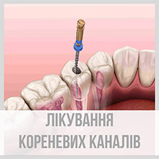 Лікування кореневих каналів