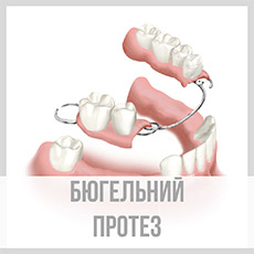 Бюгельний протез
